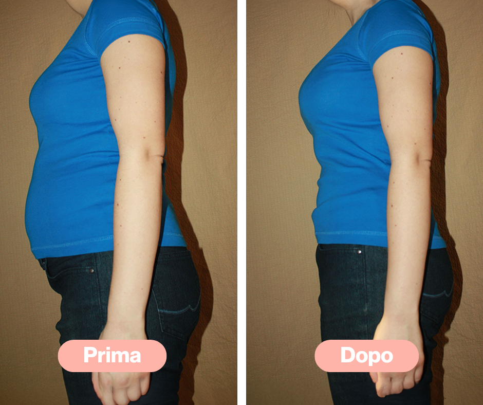 Emily: prima e dopo aver usato il pacchetto Express Body Shaper
