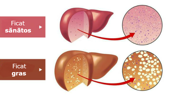 Ficatul gras sau steatoza hepatica: Cauze, Simptome si Tratament | sincanoua.ro